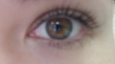 Causas e sintomas do glaucoma