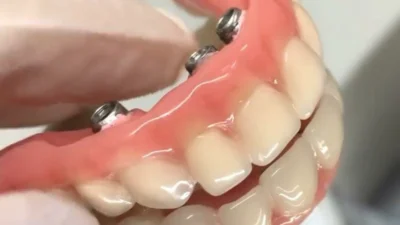 Especialista explica o que é a prótese protocolo sobre implantes