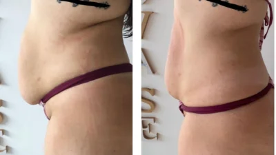 Diástase Abdominal: o que é, o que causa e como tratar?