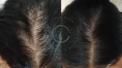 Queda capilar pós-cirurgia bariátrica