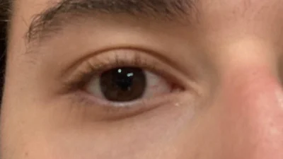 Miopia x Astigmatismo: conheça a diferença entre elas