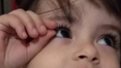 Ceratocone: entenda os tratamentos para esta doença causada nos olhos