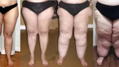 Você já ouviu falar em Lipedema? Conheça os sintomas