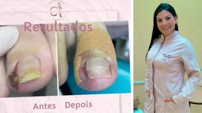 Como tratar e evitar unhas encravadas