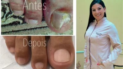 Veja a importância da Podologia no tratamento das Onicomicoses (micoses nas unhas)