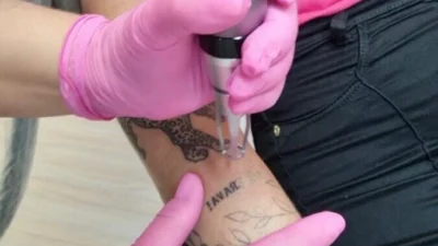 Remoção a laser de tatuagem e sobrancelhas micropigmentadas