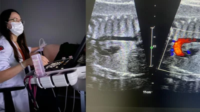 Detectando anomalias cardíacas: a importância do Ecocardiograma Fetal na saúde do bebê