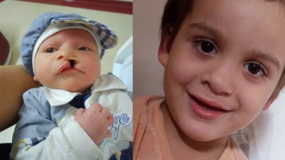A experiência de Nicolas ao ser diagnosticado com lábio leporino desde o nascimento