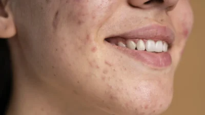Dermatologistas apostam na espironolactona como alternativa no tratamento da acne