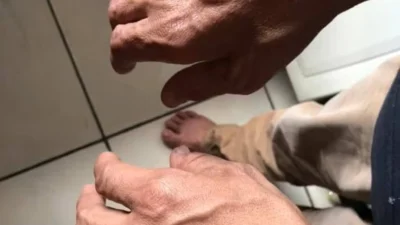 Novo tratamento brasileiro para hanseníase promete cura mais rápida e pode ser incorporado ao SUS