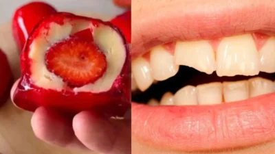 Conselho Federal de Odontologia (CFO) alerta sobre riscos do “morango do amor” para quem usa aparelho ou prótese dentária