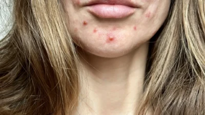 Acne adulta surpreende mulheres após os 40 anos
