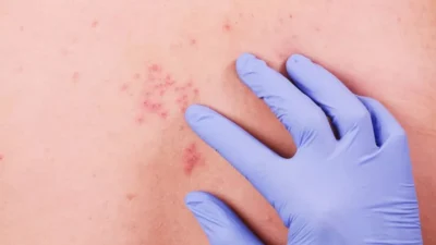 Ministério da Saúde impede inclusão da vacina contra herpes-zóster no SUS