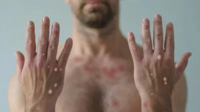 Casos de mpox crescem no Brasil e acendem alerta das autoridades de saúdeDoença viral tem registrado aumento de notificações em 2026;