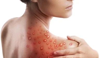 Paulínia registra primeiro caso de Mpox em 2026; paciente já está curado
